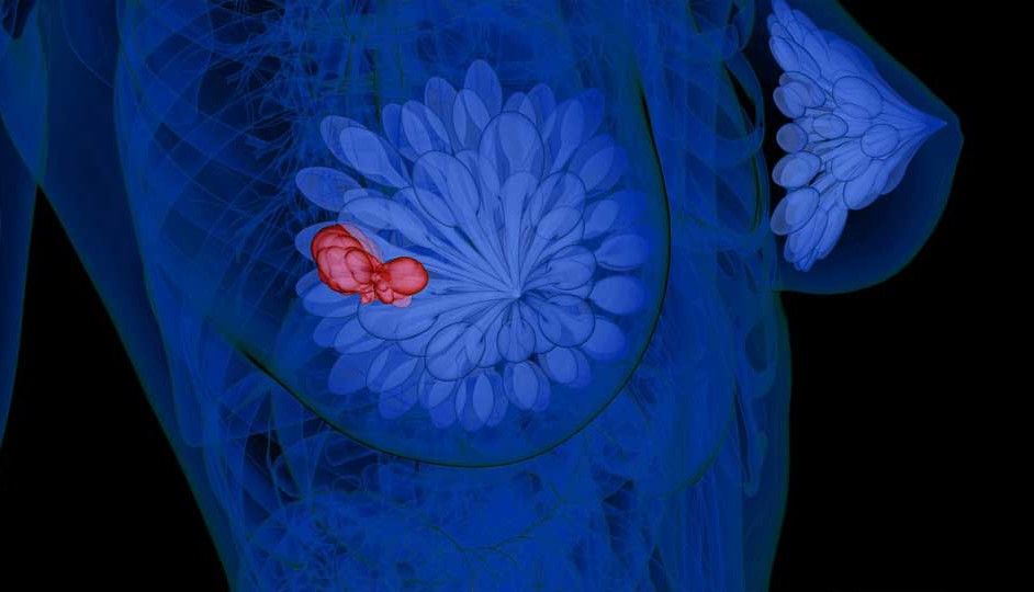 Ilustración de la detección de una neoplasia mamaria.